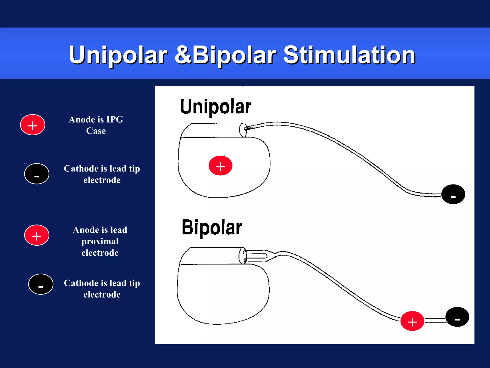 Unipolar &Bipolar StimulationUnipolar &Bipolar Stimulation
+
-
+ -
-
+
Anode is IPG
Case
Cathode is lead tip
electrode
-
+
Anode is lead
proximal
electrode
Cathode is lead tip
electrode
 