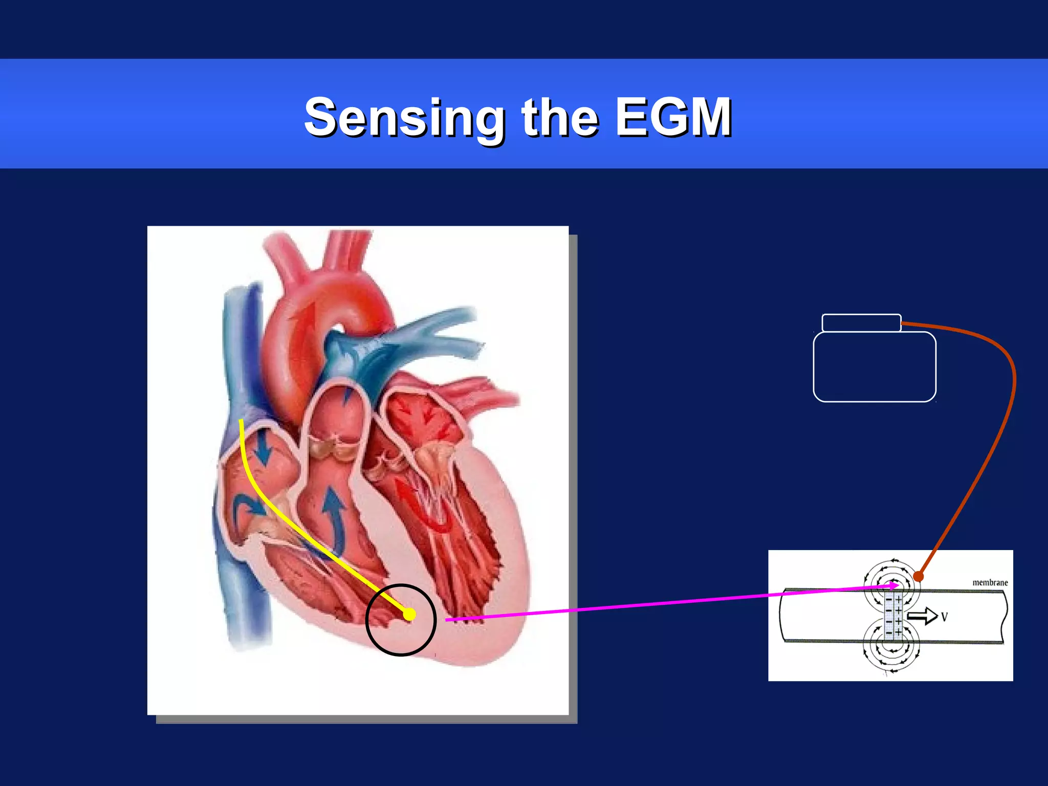 Sensing the EGMSensing the EGM
 