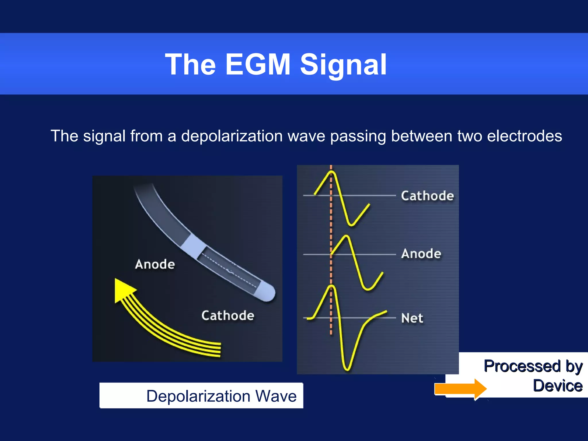 Depolarization WaveDepolarization Wave
Processed byProcessed by
DeviceDevice
Processed byProcessed by
DeviceDevice
The EGM Signal
The signal from a depolarization wave passing between two electrodes
 