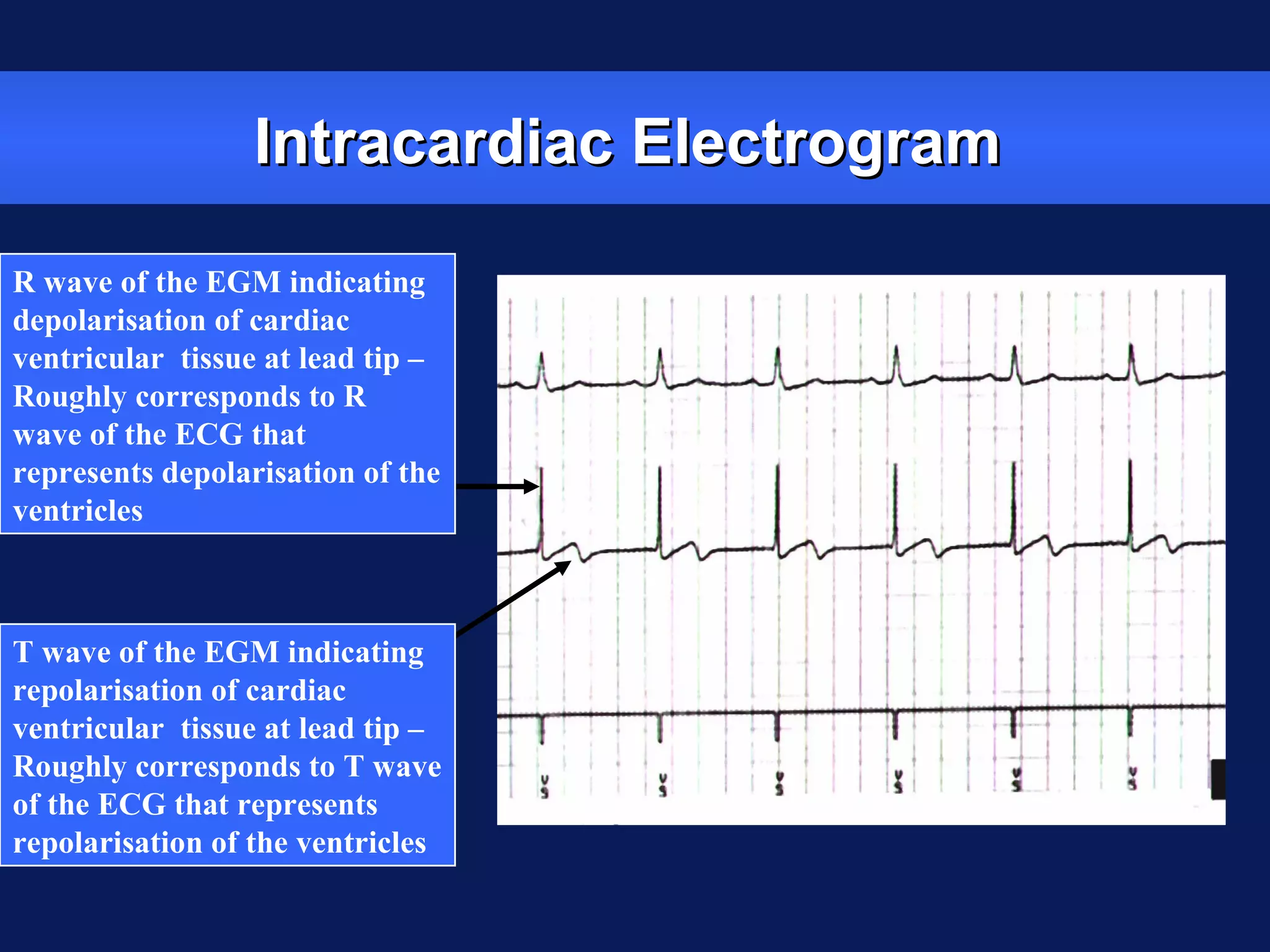 Intracardiac ElectrogramIntracardiac Electrogram
R wave of the EGM indicating
depolarisation of cardiac
ventricular tissue at lead tip –
Roughly corresponds to R
wave of the ECG that
represents depolarisation of the
ventricles
T wave of the EGM indicating
repolarisation of cardiac
ventricular tissue at lead tip –
Roughly corresponds to T wave
of the ECG that represents
repolarisation of the ventricles
 