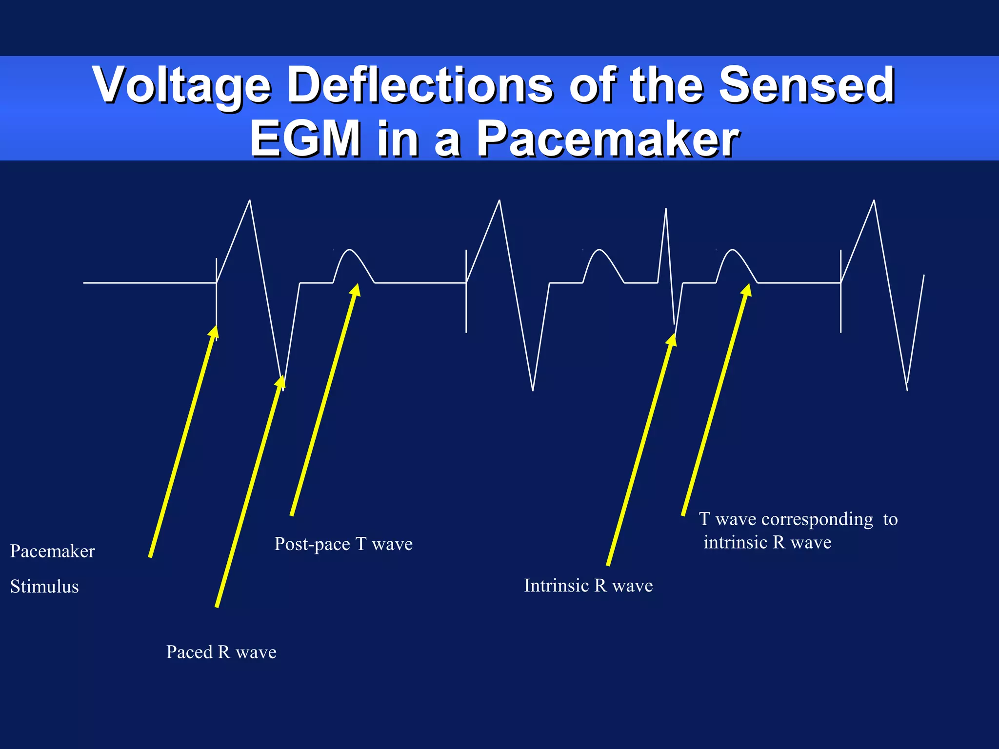 Voltage Deflections of the SensedVoltage Deflections of the Sensed
EGM in a PacemakerEGM in a Pacemaker
Pacemaker
Stimulus
Paced R wave
Post-pace T wave
Intrinsic R wave
T wave corresponding to
intrinsic R wave
 