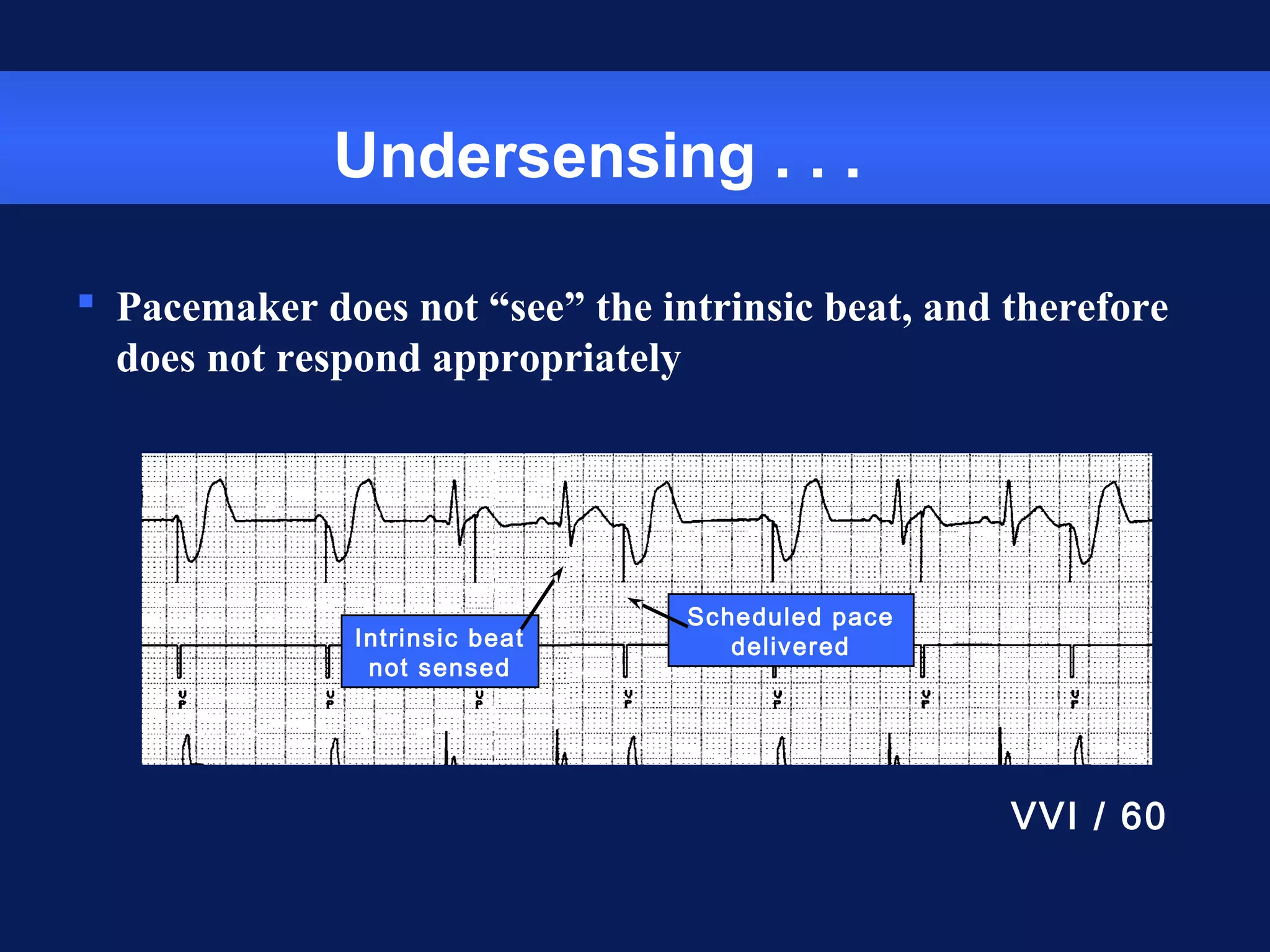 Undersensing . . .
 Pacemaker does not “see” the intrinsic beat, and therefore
does not respond appropriately
Intrinsic beat
not sensed
Scheduled pace
delivered
VVI / 60
 