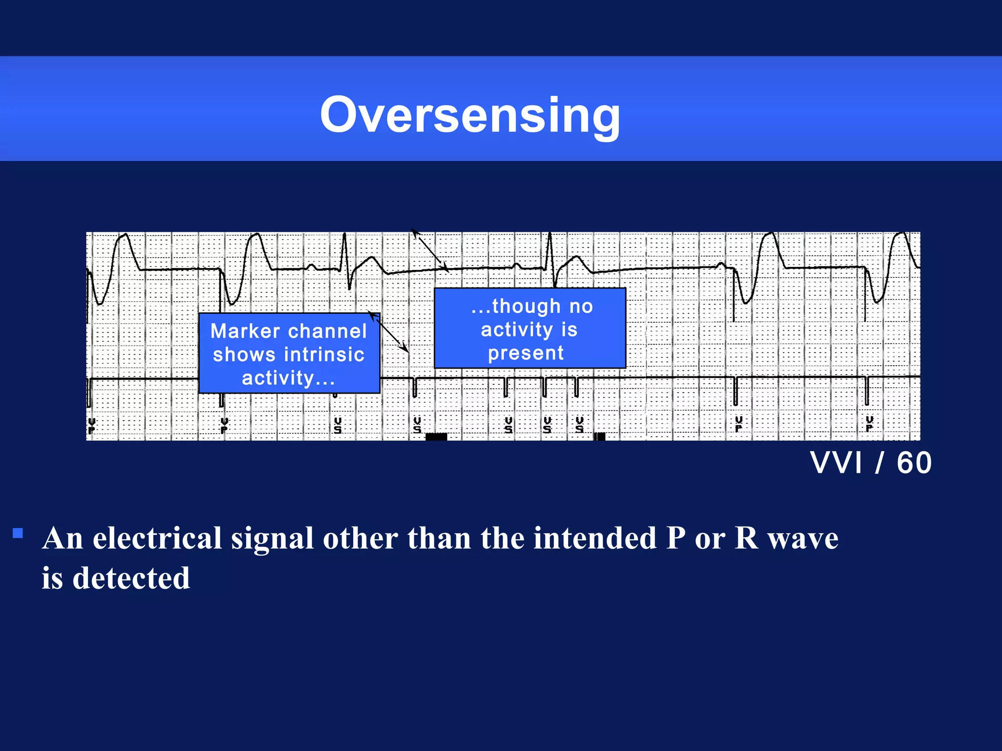 Oversensing
 An electrical signal other than the intended P or R wave
is detected
Marker channel
shows intrinsic
activity...
...though no
activity is
present
VVI / 60
 