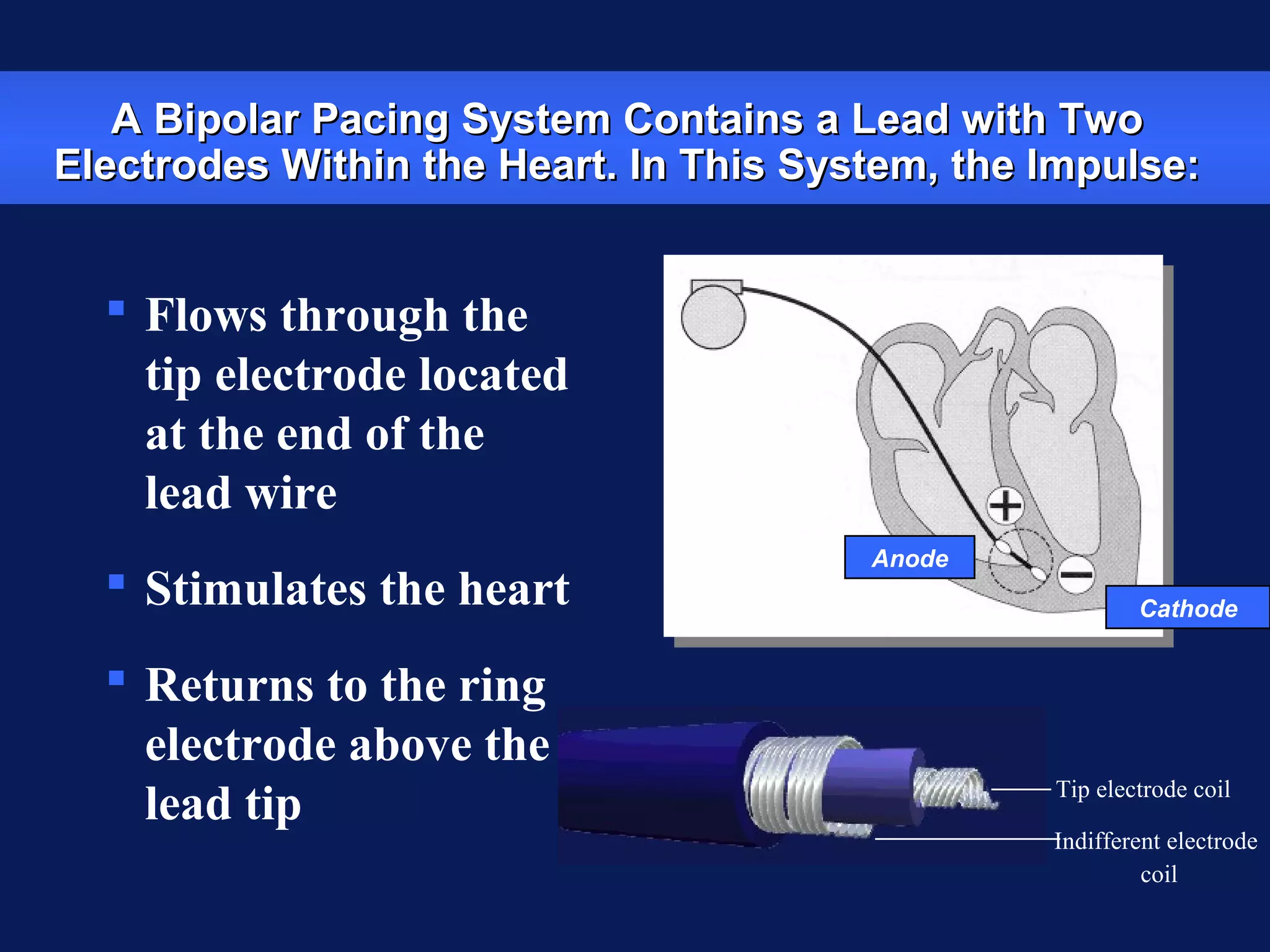 Anode
 Flows through the
tip electrode located
at the end of the
lead wire
 Stimulates the heart
 Returns to the ring
electrode above the
lead tip
A Bipolar Pacing System Contains a Lead with TwoA Bipolar Pacing System Contains a Lead with Two
Electrodes Within the Heart. In This System, the Impulse:Electrodes Within the Heart. In This System, the Impulse:
Cathode
Tip electrode coil
Indifferent electrode
coil
 