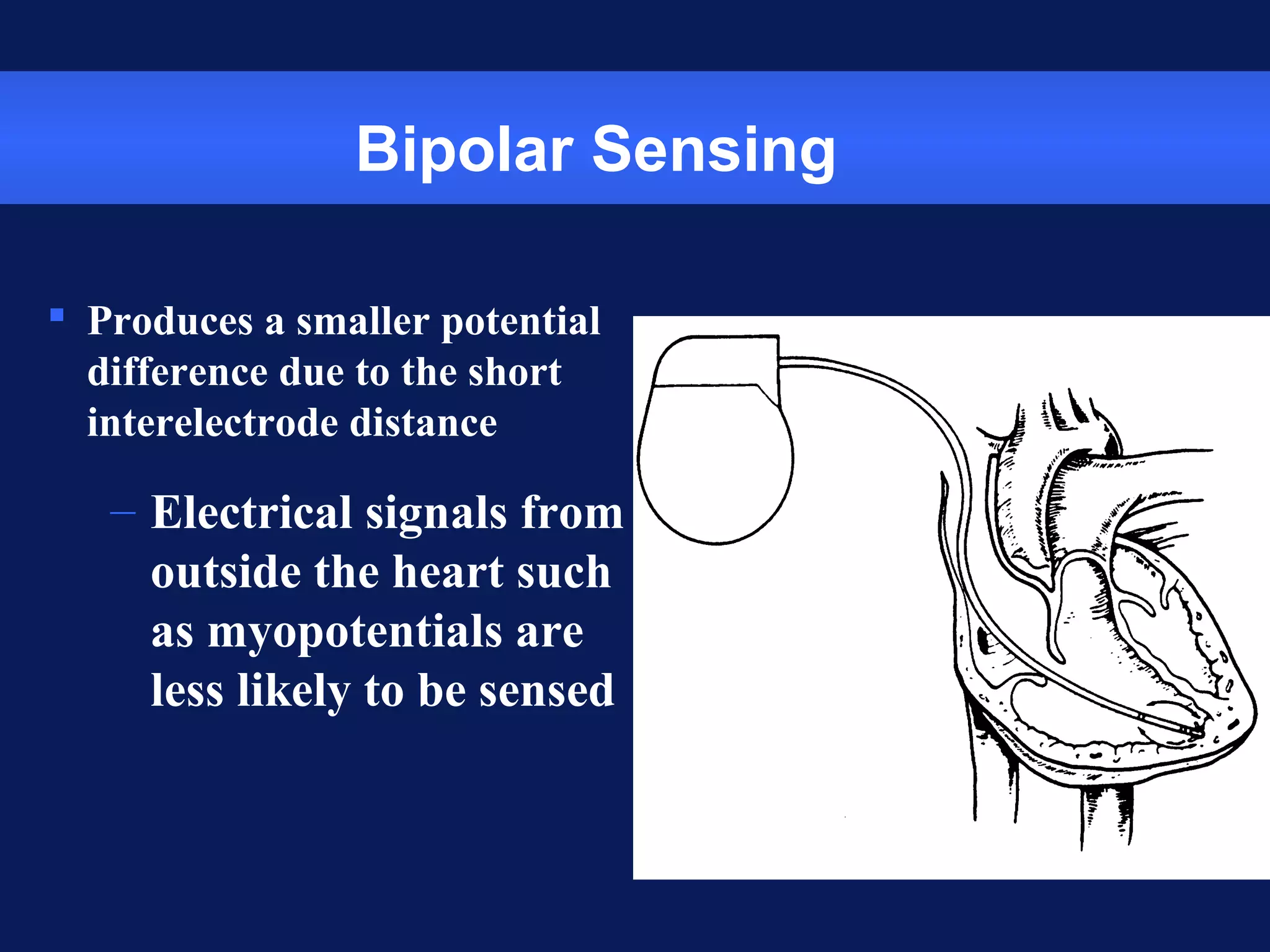 Bipolar Sensing
 Produces a smaller potential
difference due to the short
interelectrode distance
– Electrical signals from
outside the heart such
as myopotentials are
less likely to be sensed
 
