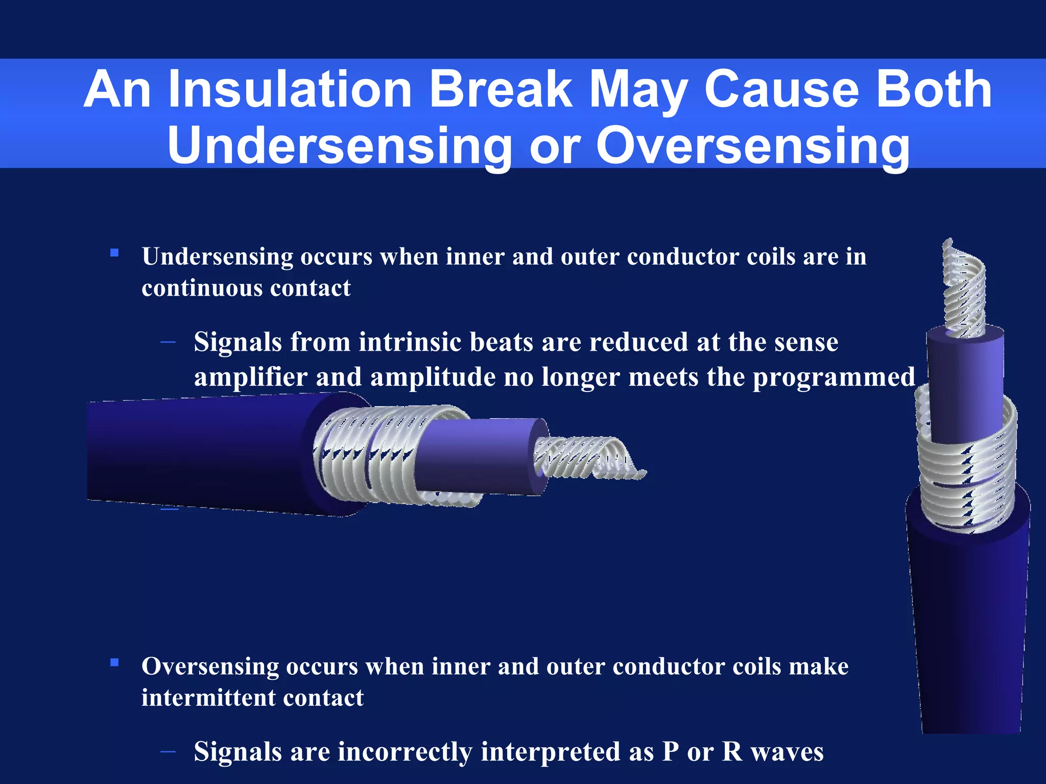 An Insulation Break May Cause Both
Undersensing or Oversensing
 Undersensing occurs when inner and outer conductor coils are in
continuous contact
– Signals from intrinsic beats are reduced at the sense
amplifier and amplitude no longer meets the programmed
sensing value
–
 Oversensing occurs when inner and outer conductor coils make
intermittent contact
– Signals are incorrectly interpreted as P or R waves
 