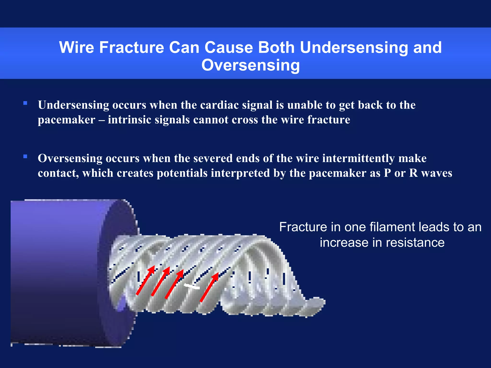 Wire Fracture Can Cause Both Undersensing and
Oversensing
 Undersensing occurs when the cardiac signal is unable to get back to the
pacemaker – intrinsic signals cannot cross the wire fracture
 Oversensing occurs when the severed ends of the wire intermittently make
contact, which creates potentials interpreted by the pacemaker as P or R waves
Fracture in one filament leads to an
increase in resistance
 