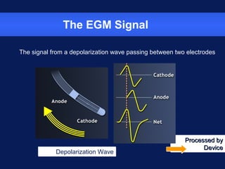 Basic technical concepts in cardiac pacing | PPT