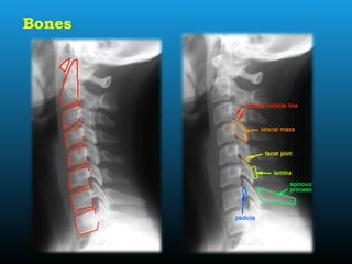 Bones
 