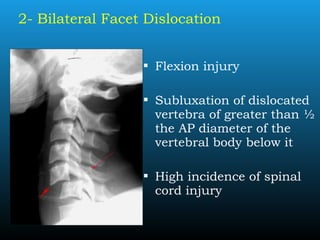 2- Bilateral Facet Dislocation
 Flexion injury
 Subluxation of dislocated
vertebra of greater than ½
the AP diameter of the
vertebral body below it
 High incidence of spinal
cord injury
 