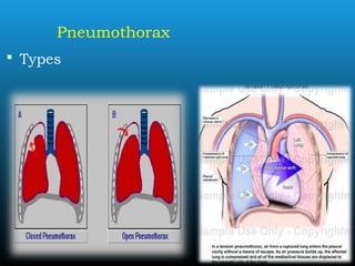 Pneumothorax
 Types
 