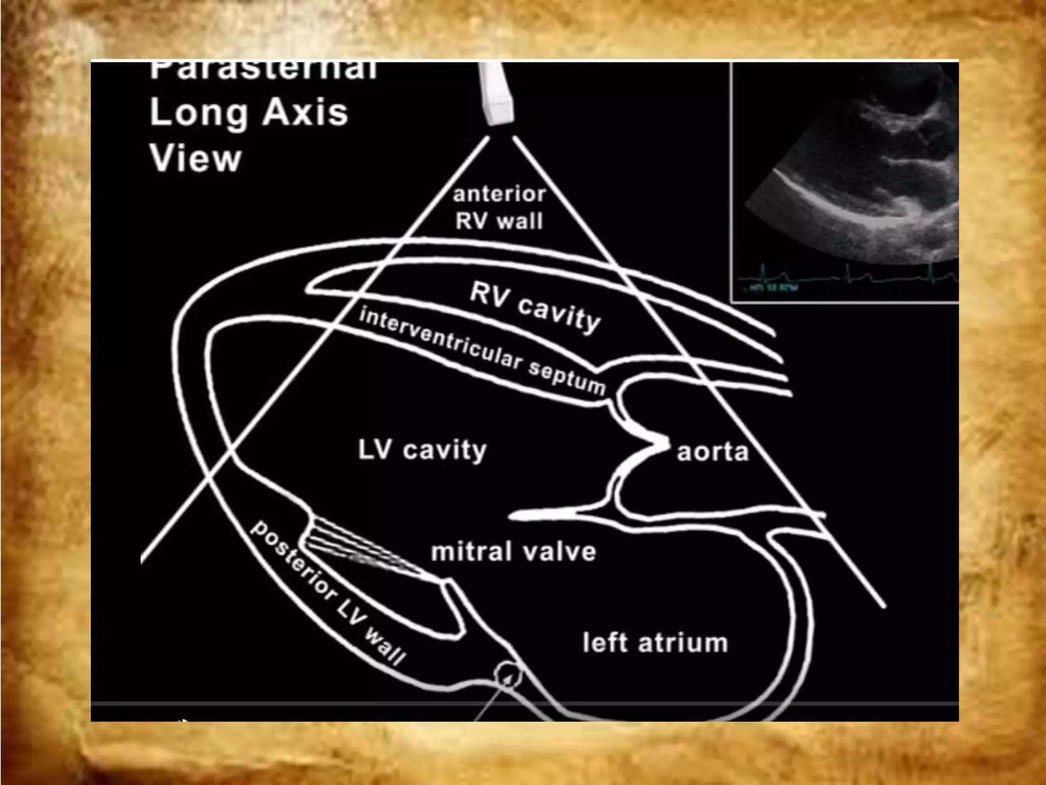 Basic ultrasound in icu | PPTX
