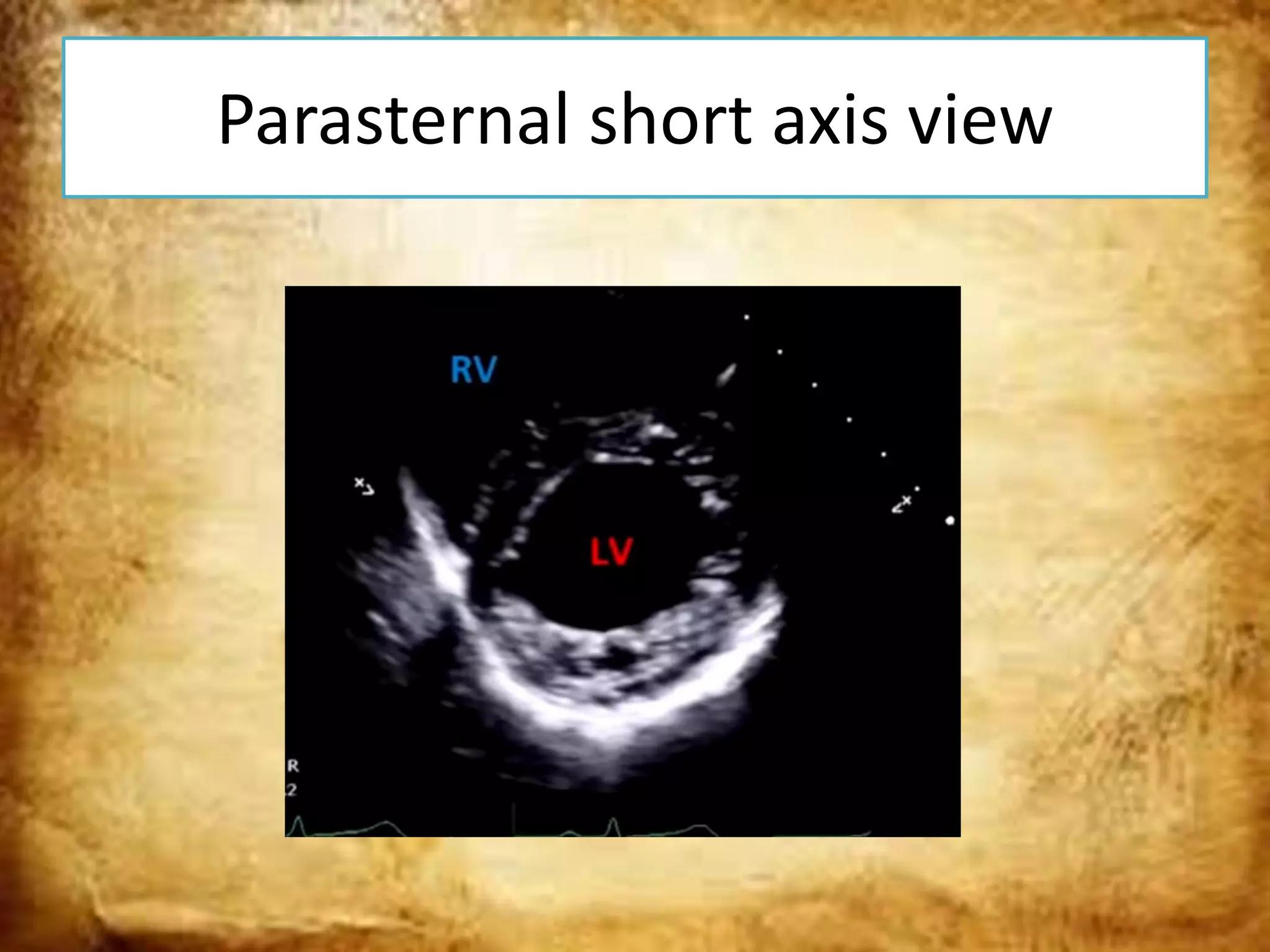 Basic ultrasound in icu | PPTX