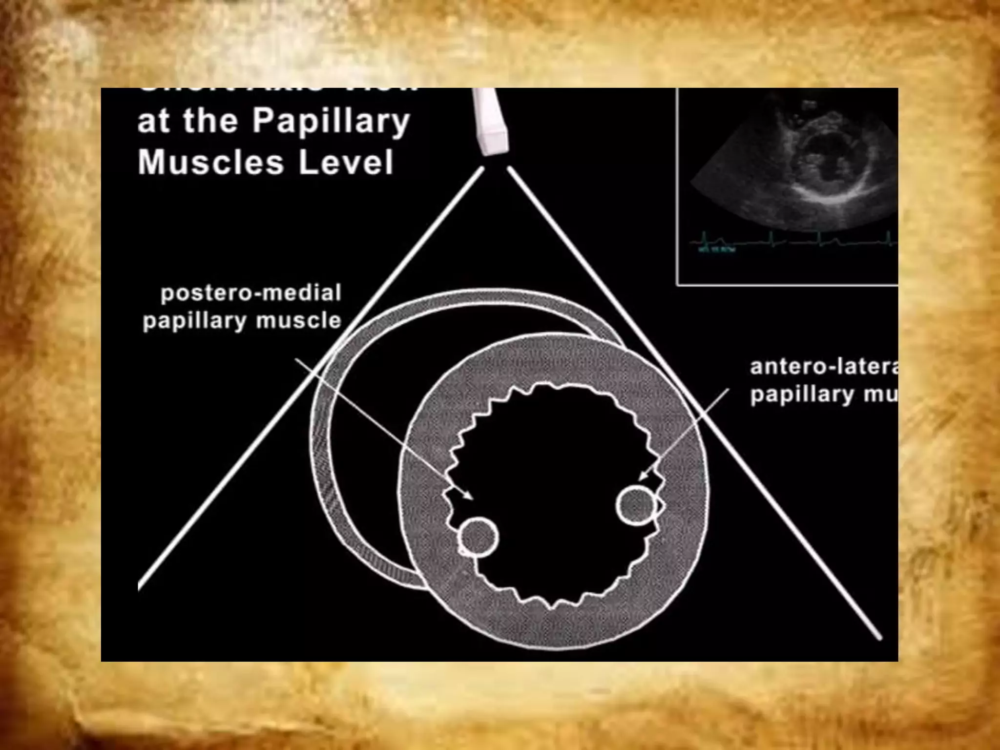 Basic ultrasound in icu | PPTX