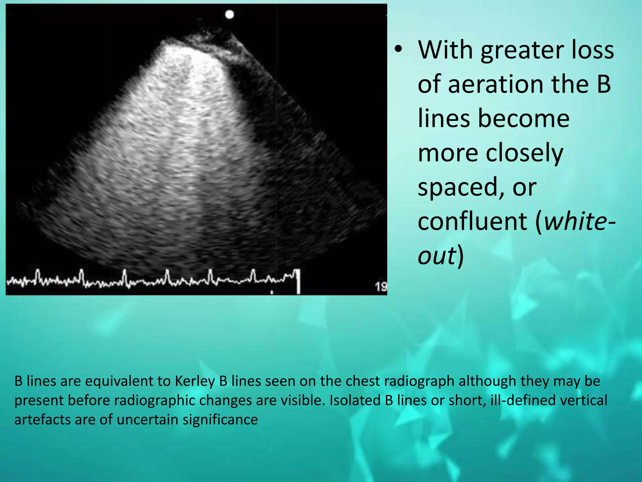 Basic ultrasound in icu | PPTX