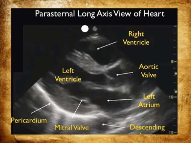 Basic ultrasound in icu | PPTX