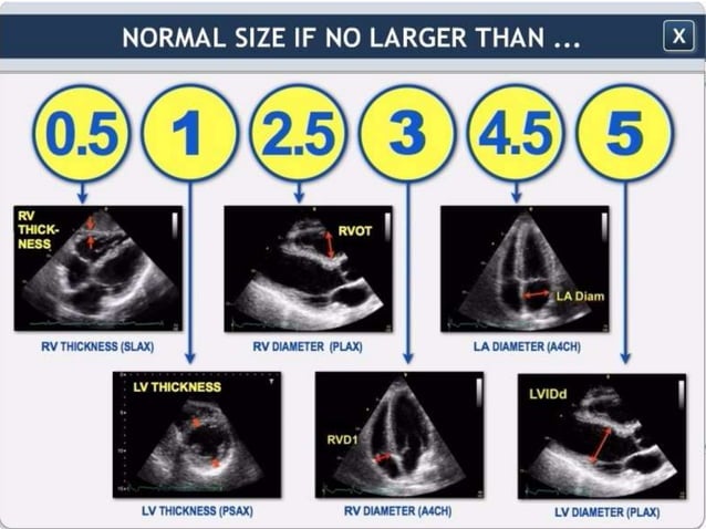 Basic ultrasound in icu | PPTX