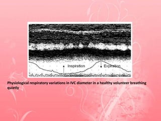 Physiological respiratory variations in IVC diameter in a healthy volunteer breathing
quietly
 