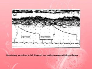 Respiratory variations in IVC diameter in a patient on controlled ventilation
 