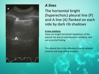 A lines
The horizontal bright
(hyperechoic) pleural line (P)
and A line (A) flanked on each
side by dark rib shadows
The pleural line is the reference line for artefact
analysis and lung sliding analysis.
A-line artefacts
these are bright horizontal repetitions of the
pleural line due to reverberation artefacts, and
are a normal finding
 