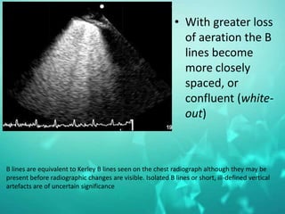 • With greater loss
of aeration the B
lines become
more closely
spaced, or
confluent (white-
out)
B lines are equivalent to Kerley B lines seen on the chest radiograph although they may be
present before radiographic changes are visible. Isolated B lines or short, ill-defined vertical
artefacts are of uncertain significance
 