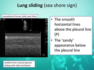 Lung sliding (sea shore sign)
• The smooth
horizontal lines
above the pleural line
(P)
• The ‘sandy’
appearance below
the pleural line
artefact from visceral pleural
sliding with tidal ventilation
extrapleural tissues static over time
 