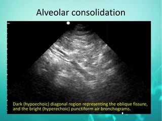 Alveolar consolidation
Dark (hypoechoic) diagonal region representing the oblique fissure,
and the bright (hyperechoic) punctiform air bronchograms.
 