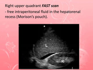 Right upper quadrant FAST scan
- free intraperitoneal fluid in the hepatorenal
recess (Morison’s pouch).
 