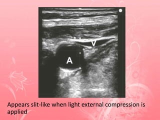 Appears slit-like when light external compression is
applied
 