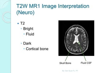 T2W MR1 Image Interpretation
(Neuro)
 T2
◦ Bright
 Fluid
◦ Dark
 Cortical bone
Skull Bone Fluid CSF
By: Gan Quan Fu, PT
 