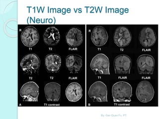 T1W Image vs T2W Image
(Neuro)
By: Gan Quan Fu, PT
 