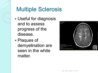 Multiple Sclerosis
 Useful for diagnosis
and to assess
progress of the
disease.
 Plaques of
demyelination are
seen in the white
matter.
By: Gan Quan Fu, PT
 