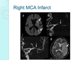Right MCA Infarct
By: Gan Quan Fu, PT
 