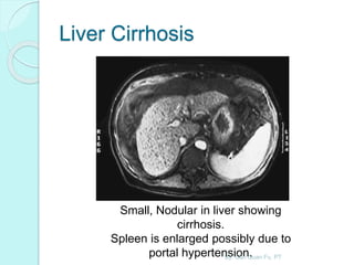 Liver Cirrhosis
Small, Nodular in liver showing
cirrhosis.
Spleen is enlarged possibly due to
portal hypertension.By: Gan Quan Fu, PT
 