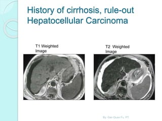History of cirrhosis, rule-out
Hepatocellular Carcinoma
T1 Weighted
Image
T2 Weighted
Image
By: Gan Quan Fu, PT
 