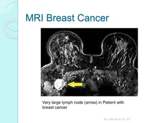 MRI Breast Cancer
Very large lymph node (arrow) in Patient with
breast cancer
By: Gan Quan Fu, PT
 