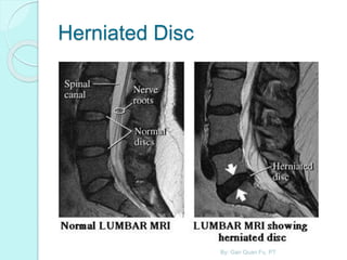 Herniated Disc
By: Gan Quan Fu, PT
 