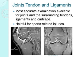 Joints Tendon and Ligaments
 Most accurate examination available
for joints and the surrounding tendons,
ligaments and cartilage.
 Helpful for sports related injuries.
By: Gan Quan Fu, PT
 
