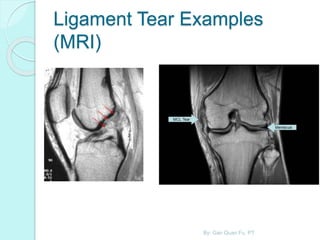 Ligament Tear Examples
(MRI)
By: Gan Quan Fu, PT
 