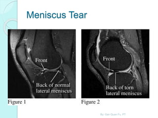 Meniscus Tear
By: Gan Quan Fu, PT
 