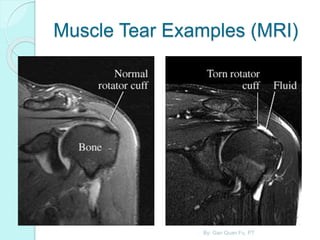 Muscle Tear Examples (MRI)
By: Gan Quan Fu, PT
 