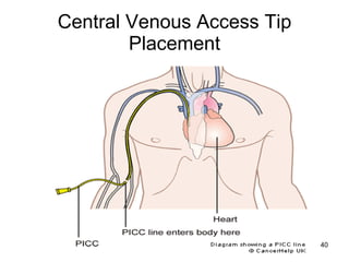 Central Venous Access Tip Placement 