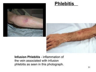   Phlebitis  Infusion Phlebitis  - inflammation of the vein associated with infusion phlebitis as seen in this photograph.  