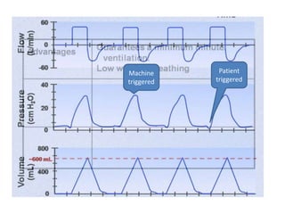 Machine
triggered
Patient
triggered
 