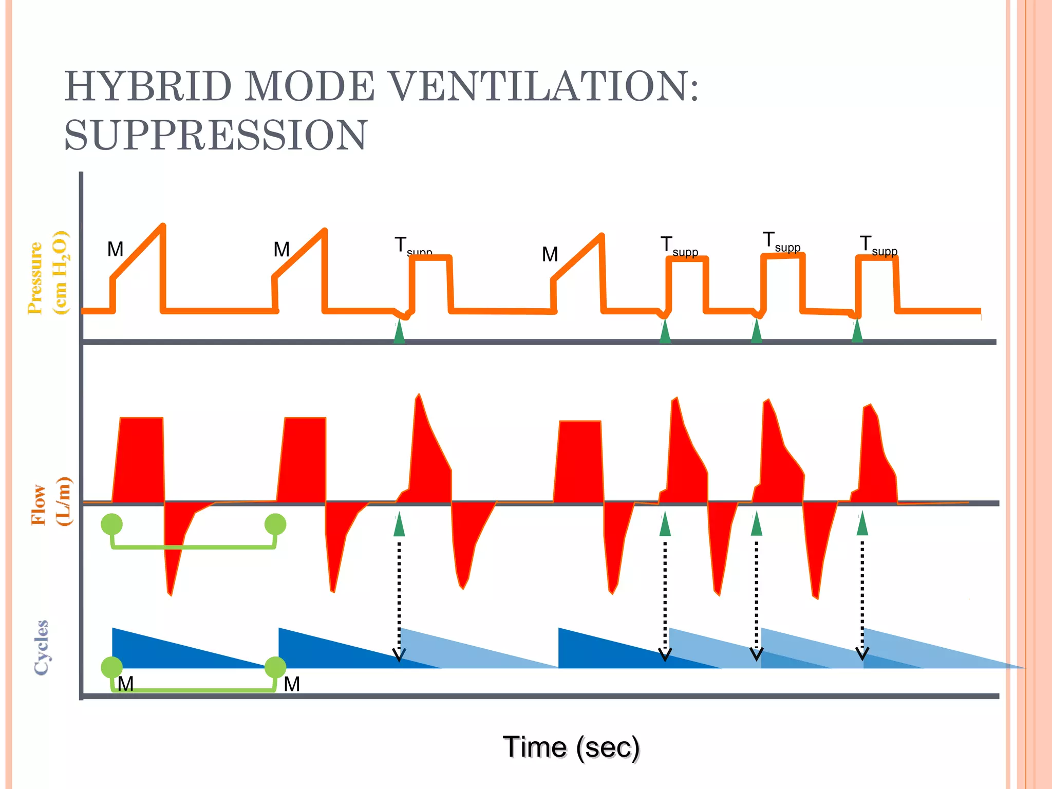 HYBRID MODE VENTILATION:
SUPPRESSION
Time (sec)Time (sec)
M Tsupp MM Tsupp
M M
Tsupp Tsupp
 