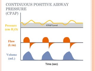 CONTINUOUS POSITIVE AIRWAY
PRESSURE
(CPAP)
Time (sec)Time (sec)
Flow
(L/m)
Pressure
(cm H2O)
Volume
(mL)
CPAP Level
 