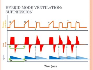 HYBRID MODE VENTILATION:
SUPPRESSION
Time (sec)Time (sec)
M Tsupp MM Tsupp
M M
Tsupp Tsupp
 