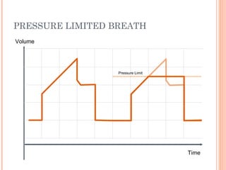 PRESSURE LIMITED BREATH
Time
Volume
Pressure Limit
 