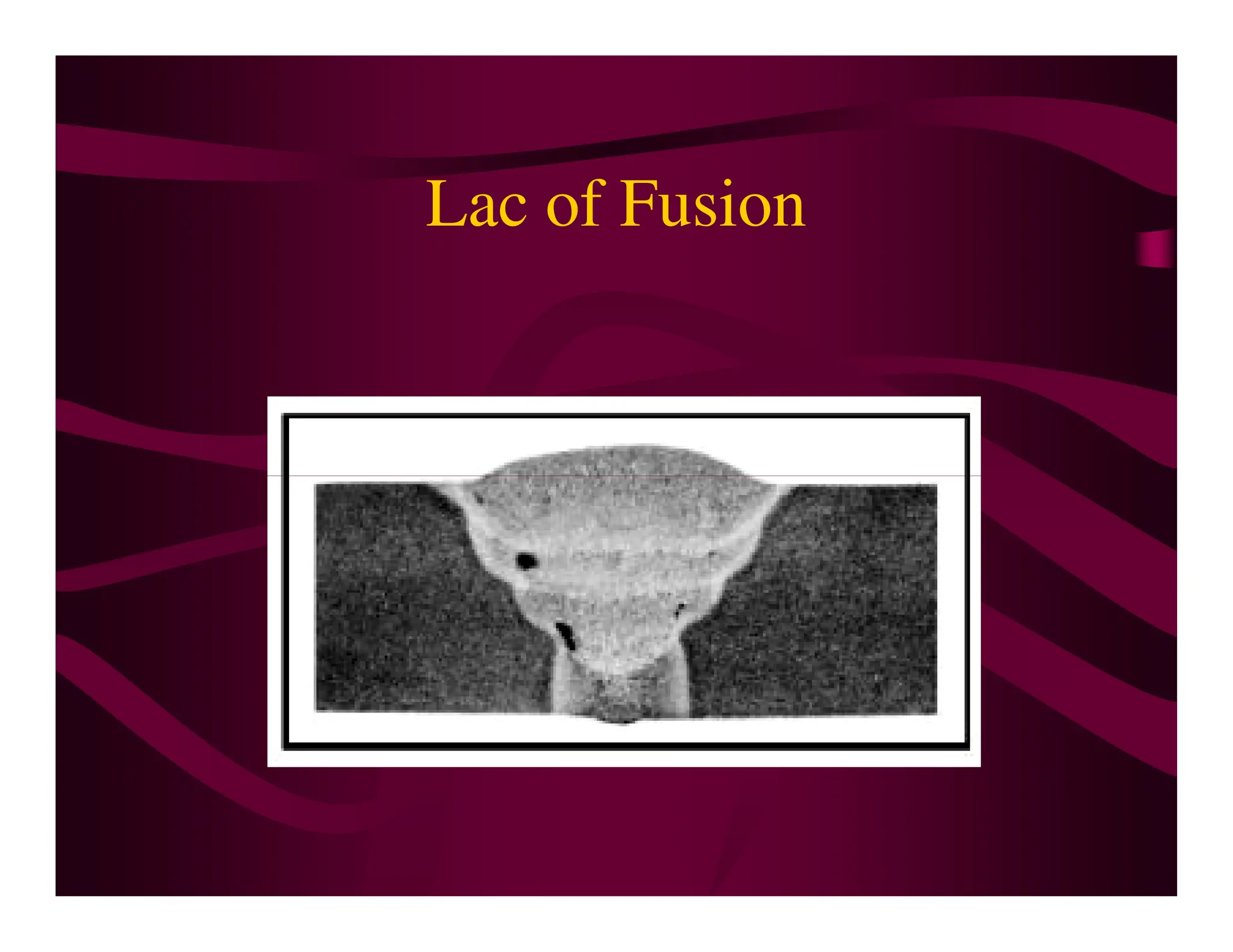 Lac of Fusion
 
