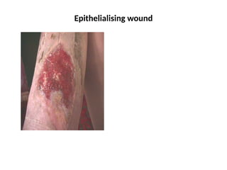Epithelialising wound
 